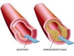 Arteriosclerose