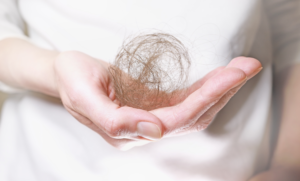 Alopecia